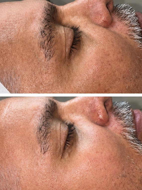Dark Spots Treatment
