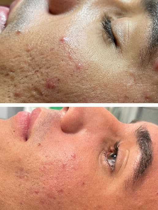 Acne Treatment