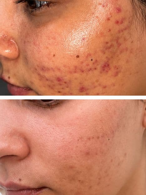 Inflammatory Acne Treatment