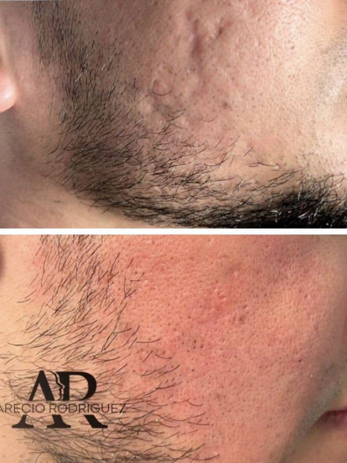 Acne Scar Treatment