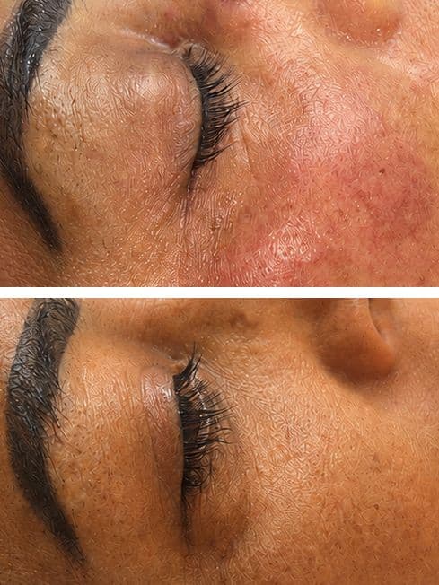 Hyperpigmentation Treatment