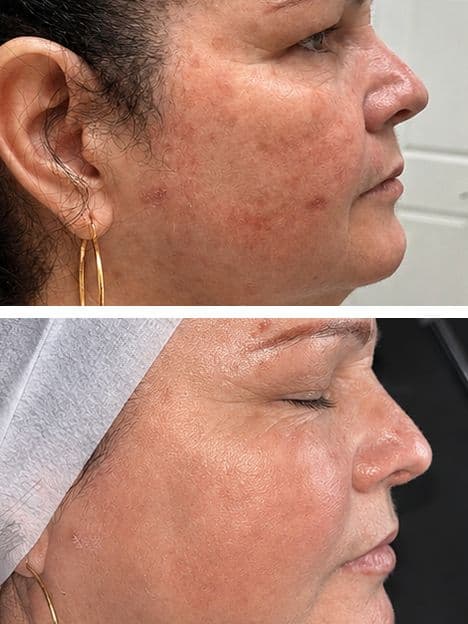 Rosacea & Sensitive Skin Treatment