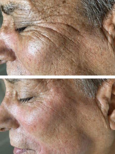 Anti-Aging Treatment