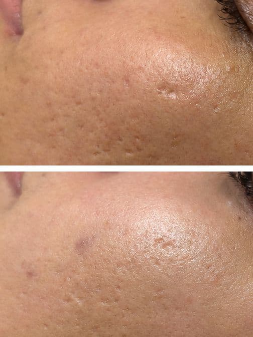 Salmon PDRN + Exosomes with Microneedling