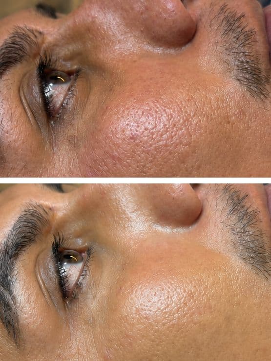 Facial + Microdermabrasion + Deep Hydration
