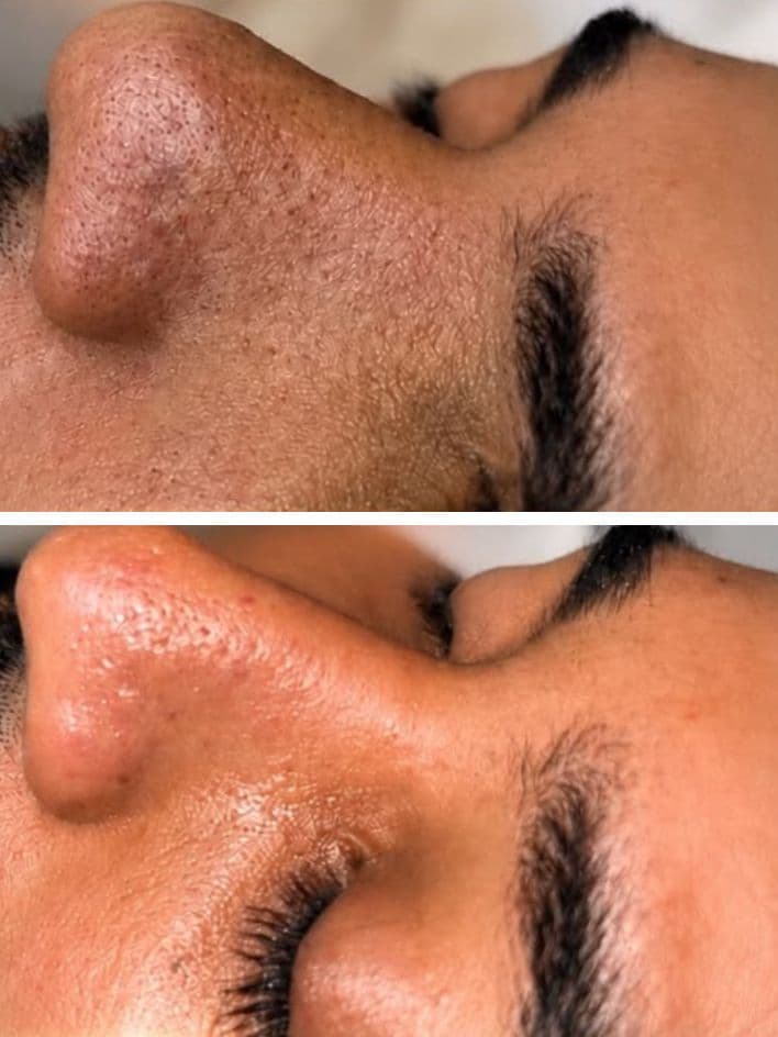 Deep Cleansing Facial + Chemical Peel