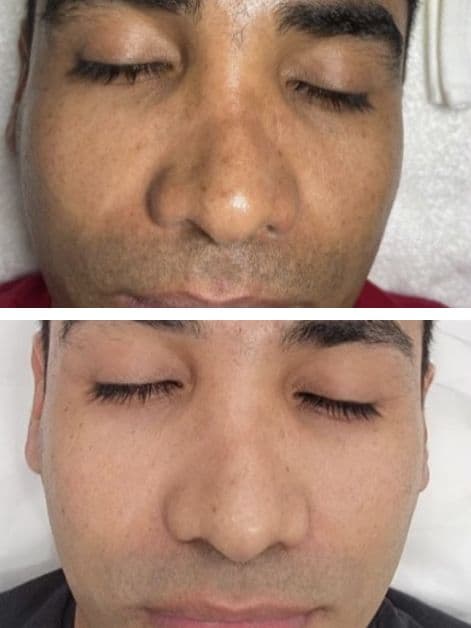 Chemical Peel