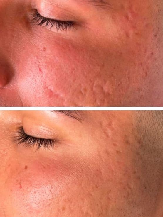Microneedling for Acne Scars